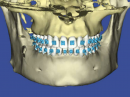 root-planning-with-cbct-scans